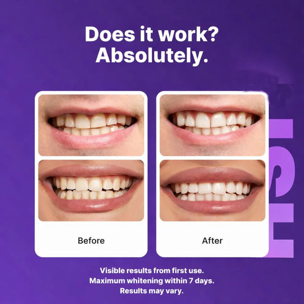 👉 Whiter Teeth Without Expensive Dental Visits